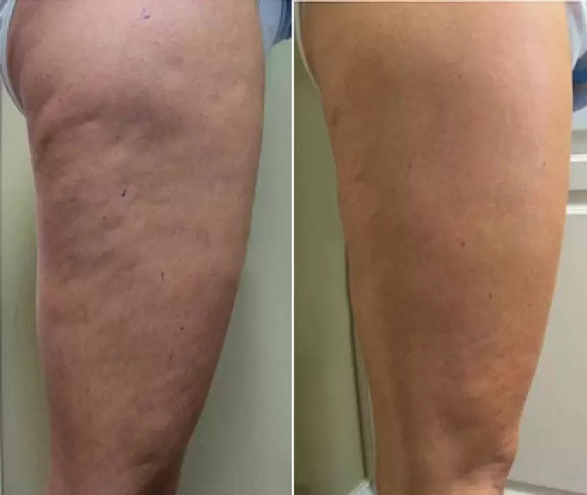 Foto prima e dopo l'utilizzo del gel Vetonus di Suzanne di Vilnius